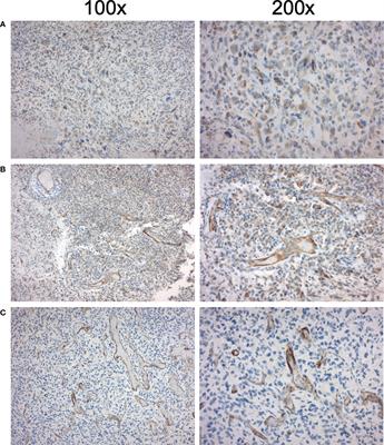 [68Ga]Ga-PSMA PET/MRI, histological PSMA expression and preliminary experience with [177Lu]Lu-PSMA therapy in relapsing high-grade glioma